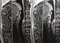2 tiếng mổ cấp cứu “giải phóng” bệnh nhân liệt toàn thân vì giác hơi