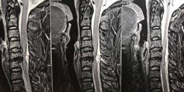 2 tiếng mổ cấp cứu “giải phóng” bệnh nhân liệt toàn thân vì giác hơi