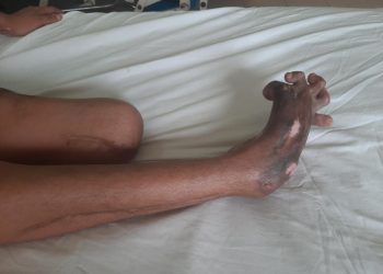 Bảo tồn và chỉnh hình cẳng bàn chân khuyết tật