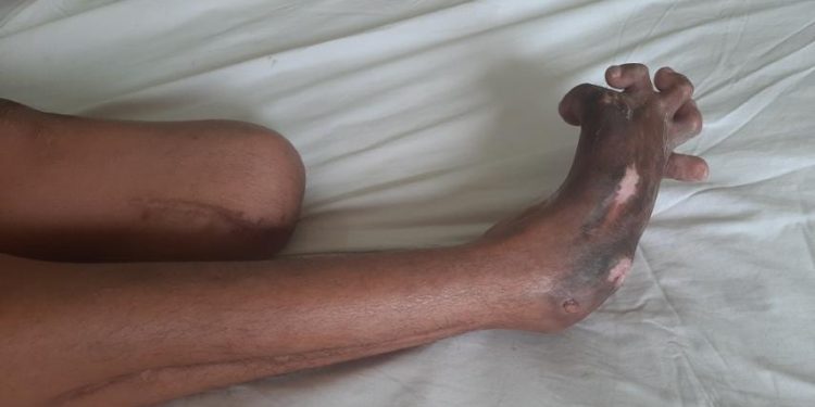 Bảo tồn và chỉnh hình cẳng bàn chân khuyết tật