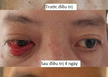 Bệnh viện Đa khoa tỉnh Khánh Hòa điều trị thành công rò động mạch cảnh xoang hang