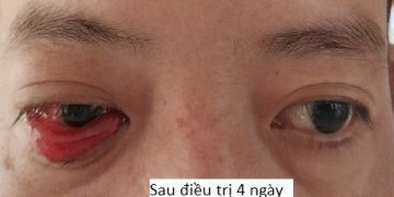 Bệnh viện Đa khoa tỉnh Khánh Hòa điều trị thành công rò động mạch cảnh xoang hang