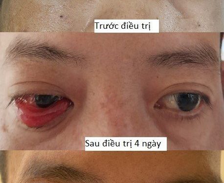 Bệnh viện Đa khoa tỉnh Khánh Hòa điều trị thành công rò động mạch cảnh xoang hang