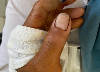 Cứu sống nạn nhân choáng mất máu do đứt động mạch cánh tay