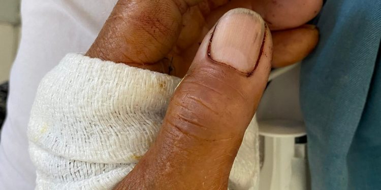 Cứu sống nạn nhân choáng mất máu do đứt động mạch cánh tay