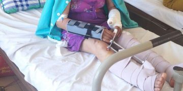 Cứu sống bệnh nhân gãy hở tứ chi do tai nạn giao thông