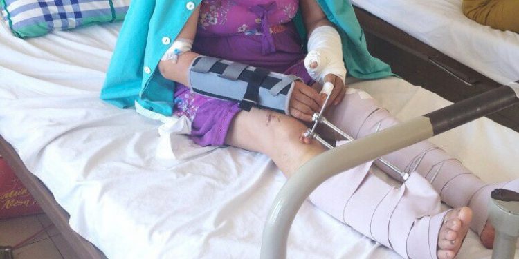 Cứu sống bệnh nhân gãy hở tứ chi do tai nạn giao thông