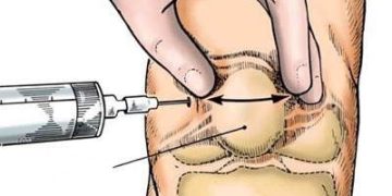 Chiêu sinh lớp đào tạo “Kỹ thuật tiêm khớp, tiêm gân”