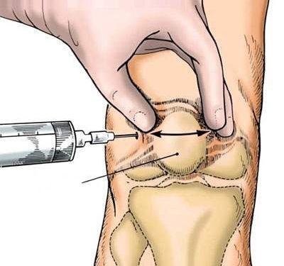 Chiêu sinh lớp đào tạo “Kỹ thuật tiêm khớp, tiêm gân”