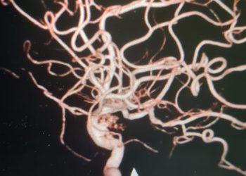 Điều trị túi phình động mạch cảnh bằng phương pháp can thiệp nội mạch thần kinh