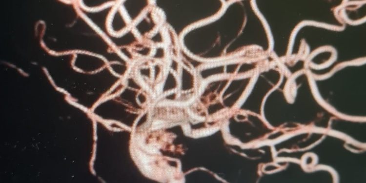 Điều trị túi phình động mạch cảnh bằng phương pháp can thiệp nội mạch thần kinh