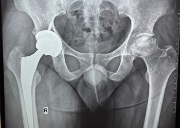 Hoại tử (tiêu) chỏm xương đùi