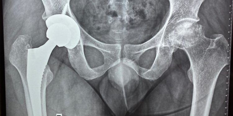 Hoại tử (tiêu) chỏm xương đùi