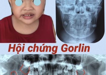 Hội chứng Gorlin – Bé trai 9 tuổi