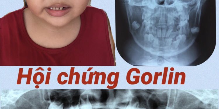 Hội chứng Gorlin – Bé trai 9 tuổi