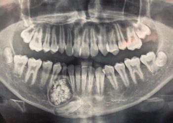 Hi hữu: Lấy gần 100 cái răng trong miệng một thiếu niên ở Khánh Hòa