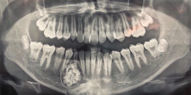 Hi hữu: Lấy gần 100 cái răng trong miệng một thiếu niên ở Khánh Hòa