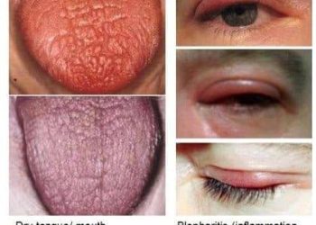 Hội chứng Sjögren