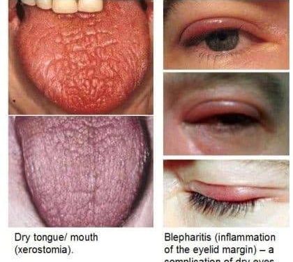 Hội chứng Sjögren