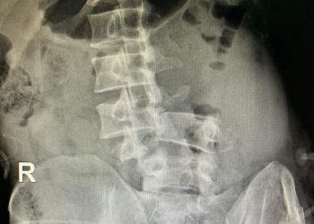 Nạn nhân gãy phức tạp cột sống L3-L5