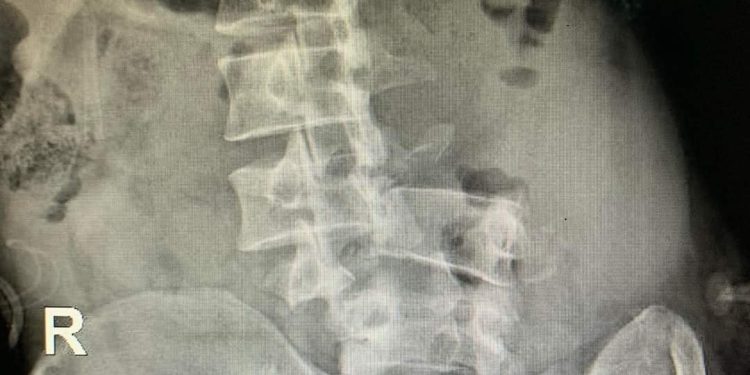 Nạn nhân gãy phức tạp cột sống L3-L5