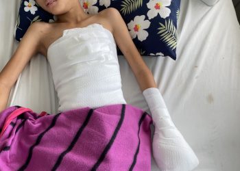 Nát bàn tay do pháo nổ