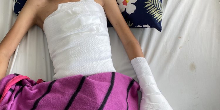 Nát bàn tay do pháo nổ