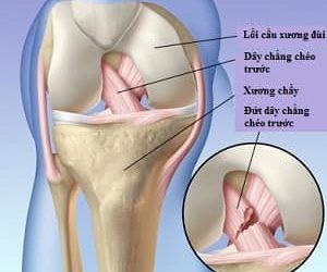 Phẫu thuật nội soi tái tạo dây chằng chéo trước