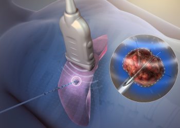 Đề tài cấp tỉnh: Ứng dụng phương pháp phá hủy khối u gan tại chỗ bằng vi sóng trong điều trị ung thư biểu mô tế bào gan tại Bệnh viện Đa khoa tỉnh Khánh Hòa