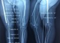 Phẫu thuật bệnh nhân bị bệnh xương thủy tinh