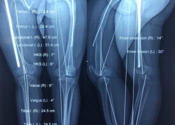 Phẫu thuật bệnh nhân bị bệnh xương thủy tinh