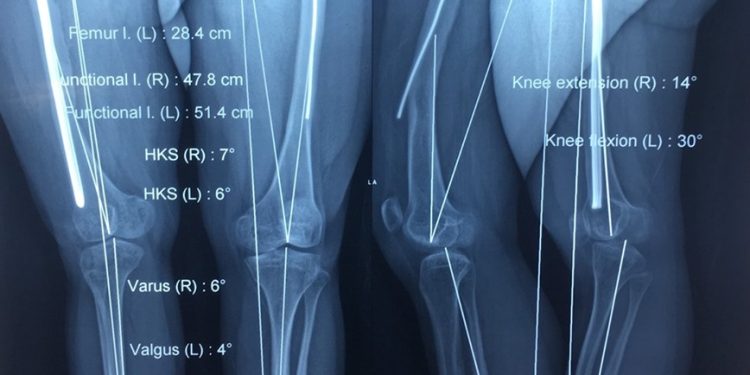 Phẫu thuật bệnh nhân bị bệnh xương thủy tinh