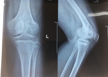 Phẫu thuật điều trị rối loạn phát triển sụn tăng trưởng đầu dưới xương đùi cho bệnh nhân nhi