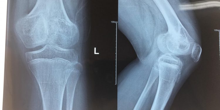 Phẫu thuật điều trị rối loạn phát triển sụn tăng trưởng đầu dưới xương đùi cho bệnh nhân nhi