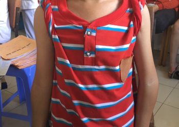 Phẫu thuật thành công: Biến dạng khuỷu vẹo trong cho bệnh nhân nhi