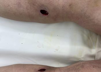 Spa tiêm filler gây áp-xe gối và cẳng chân