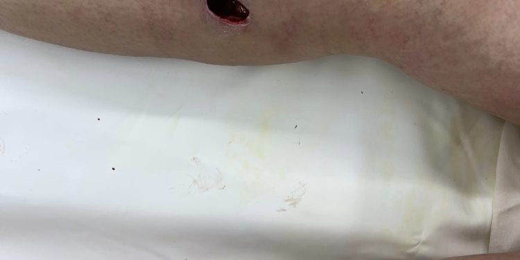 Spa tiêm filler gây áp-xe gối và cẳng chân