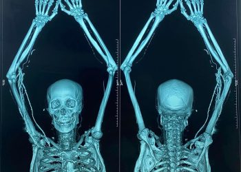 Tắc động mạch cánh tay trái do huyết khối