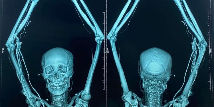 Tắc động mạch cánh tay trái do huyết khối