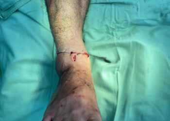 Nối thành công đứt lìa cổ chân tại Bệnh viện Đa khoa tỉnh Khánh Hòa