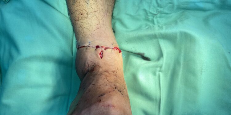 Nối thành công đứt lìa cổ chân tại Bệnh viện Đa khoa tỉnh Khánh Hòa