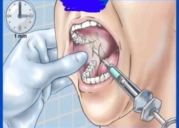 Xử lý cấp cứu thành công 01 ca dị vật khó vùng răng hàm mặt