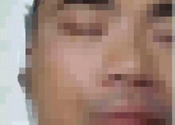 Điều trị phẫu thuật thành công bệnh lý co giật nửa mặt tại Bệnh viện Đa khoa tỉnh Khánh Hòa