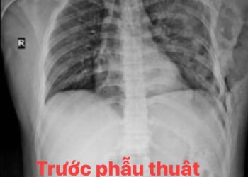 Kỹ thuật mới “Phẫu thuật kết hợp xương sườn gãy bằng nẹp vít titan”