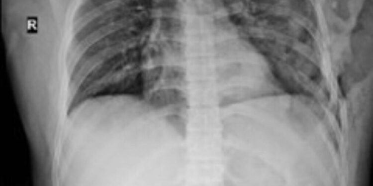 Kỹ thuật mới “Phẫu thuật kết hợp xương sườn gãy bằng nẹp vít titan”