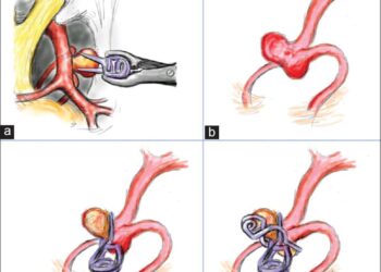 Vi phẫu thuật điều trị túi phình động mạch não tại Bệnh viện Đa khoa tỉnh Khánh Hòa