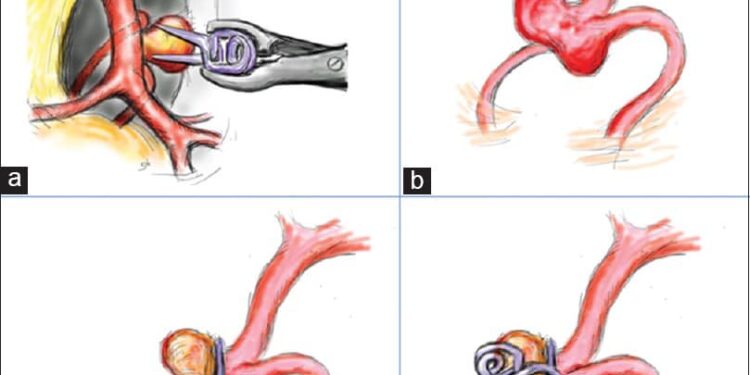 Vi phẫu thuật điều trị túi phình động mạch não tại Bệnh viện Đa khoa tỉnh Khánh Hòa