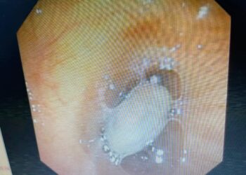 Gắp thành công hạt sa pô chê trong cơ thể người hơn 20 năm tại Bệnh viện Đa khoa tỉnh Khánh Hòa