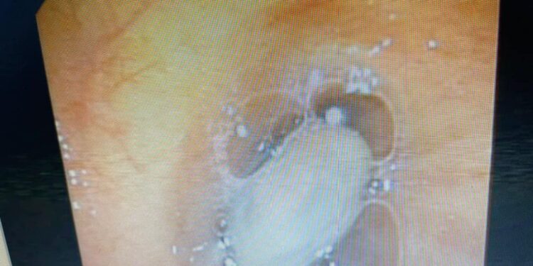 Gắp thành công hạt sa pô chê trong cơ thể người hơn 20 năm tại Bệnh viện Đa khoa tỉnh Khánh Hòa