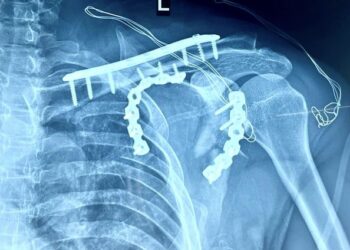 Mổ thành công ca gãy bập bềnh khớp vai tại Bệnh viện Đa khoa tỉnh Khánh Hòa